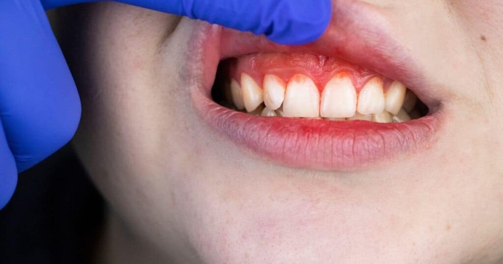Gingivitis and periodontal disease signs and symptoms