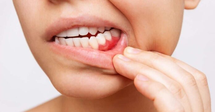 keep your teeth with periodontal disease